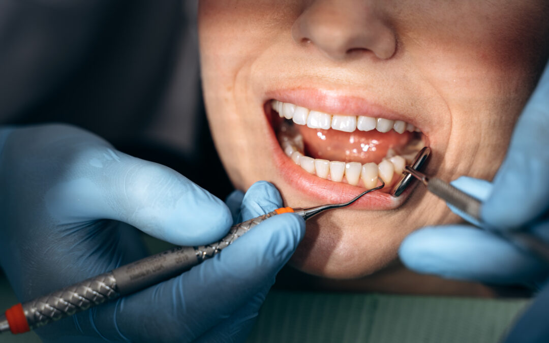 Tooth Decay Causes and Treatment in Lawrence, NY