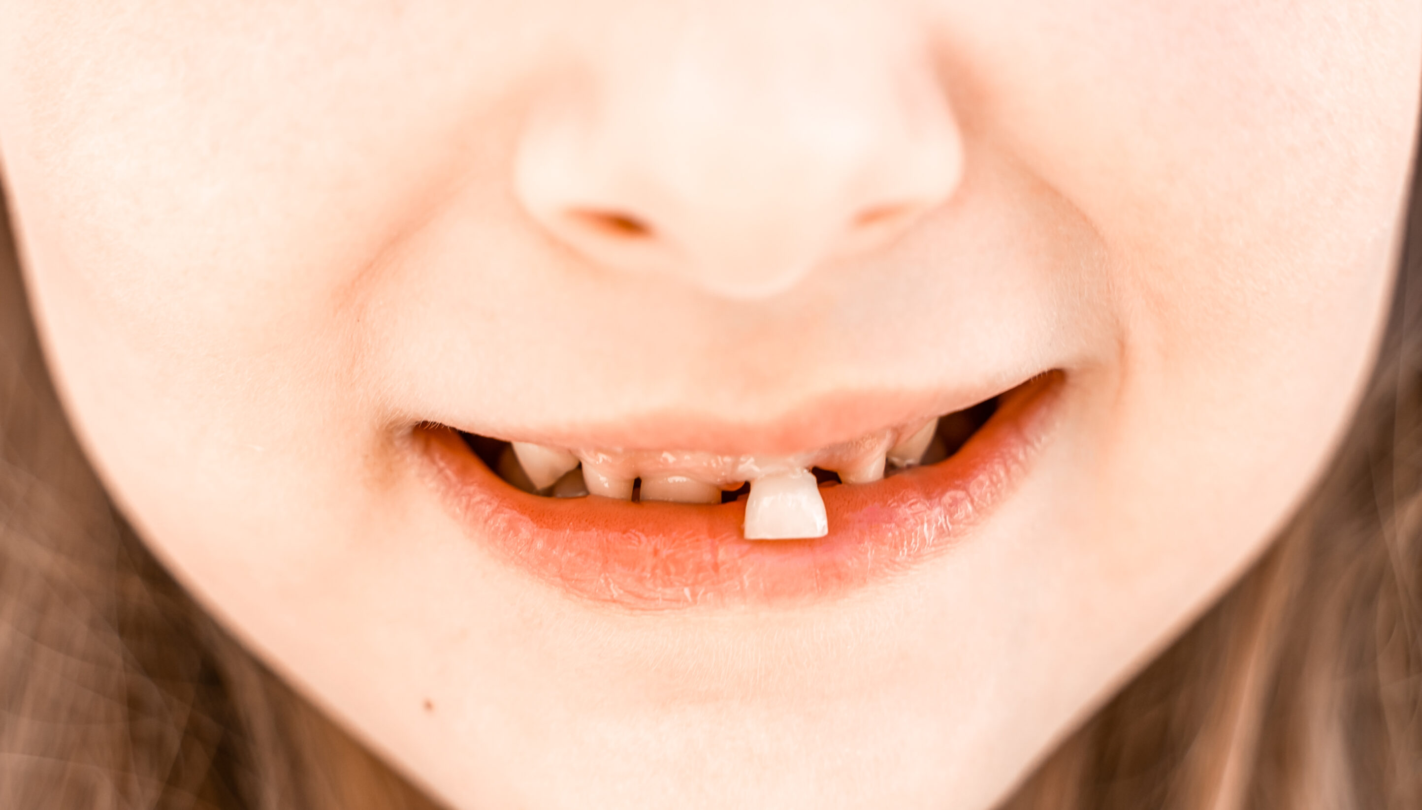 Pediatric dentist treating a knocked-out permanent tooth after a dental injury