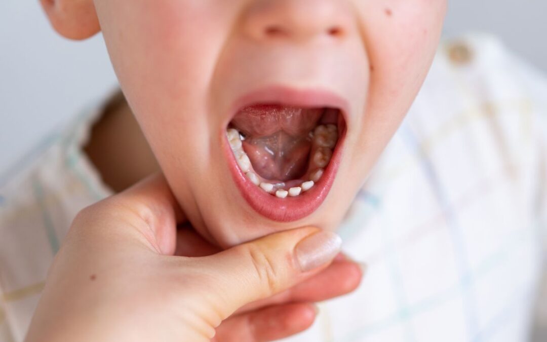 What Happens If a Cavity in a Baby Tooth Is Left Untreated?