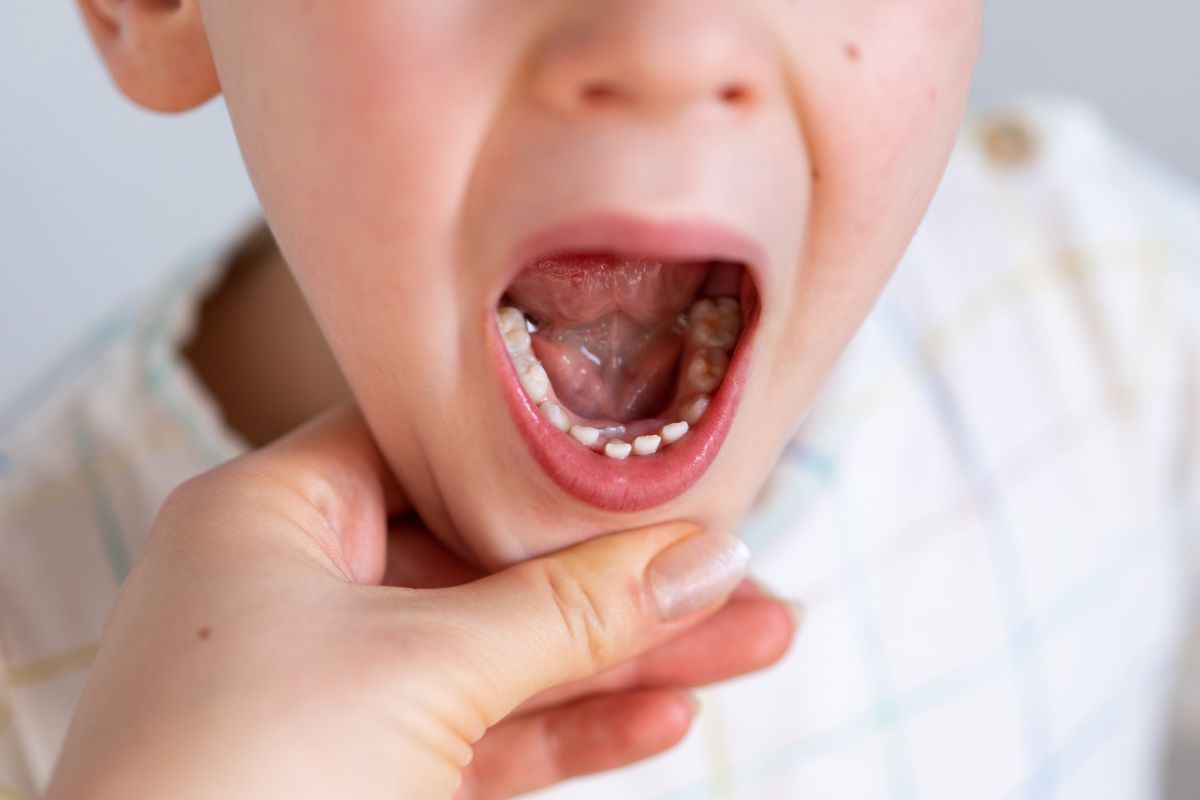 What Happens If a Cavity in a Baby Tooth Is Left Untreated Child with a visible cavity in a baby tooth needing dental treatment